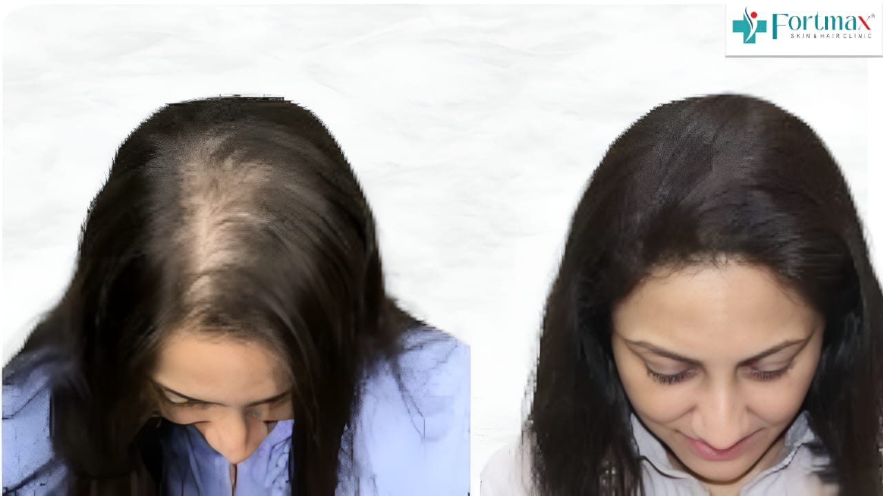 Female-hair-transplant